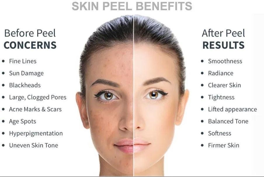 Understanding Chemical Peels