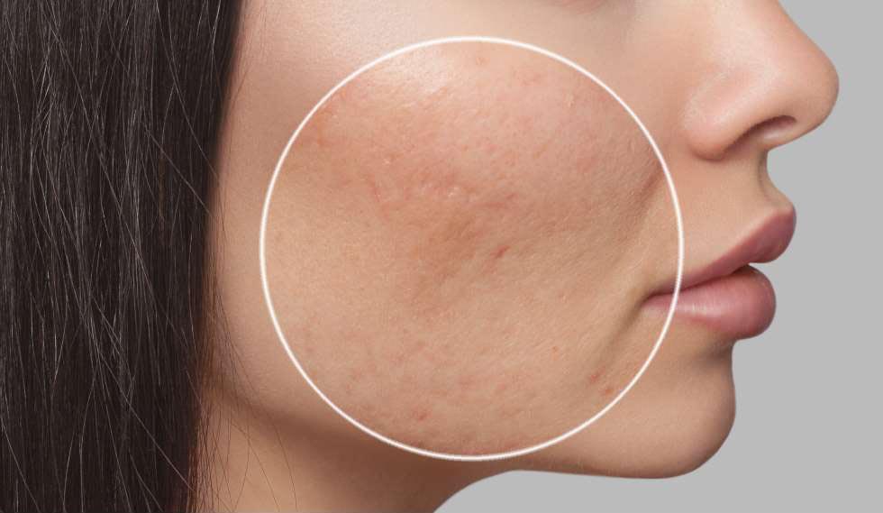 How to Fix Stubborn Acne Scars: The Most Effective Treatments