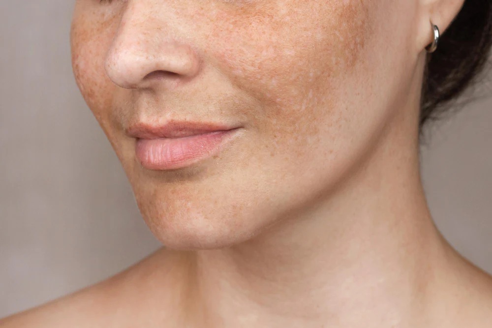 Melasma Treatment Options That Actually Work